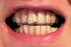Maultrommel Zahnschutz 2